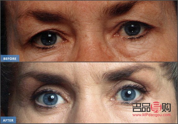 <h3>眼皮抽脂手術(shù)前后對(duì)比</h3>