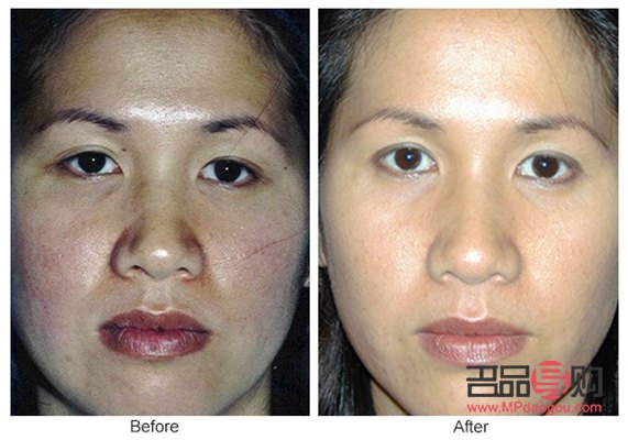 <h3>眼皮抽脂手術(shù)前后對(duì)比</h3>