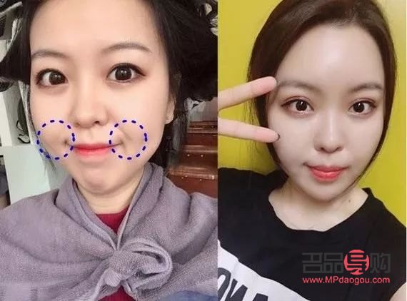 去皺美容針多少錢(美容去皺紋針多少錢一針)