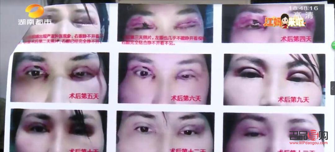 目前割雙眼皮手術(shù)費(fèi)用知多少？