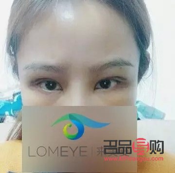 眼窩填充自體脂肪存活能維持多久(眼窩填充自體脂肪存活能維持多久呢)