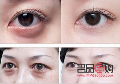 眼袋什么年齡去除最好(眼袋什么年齡去除最好圖片)