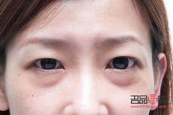 眼袋什么年齡去除最好(眼袋什么年齡去除最好圖片)