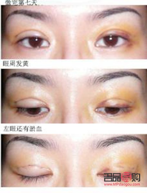 大眼綜合真實恢復(fù)期圖片(大眼綜合的恢復(fù)過程)