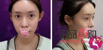 大眼綜合真實恢復(fù)期圖片(大眼綜合的恢復(fù)過程)