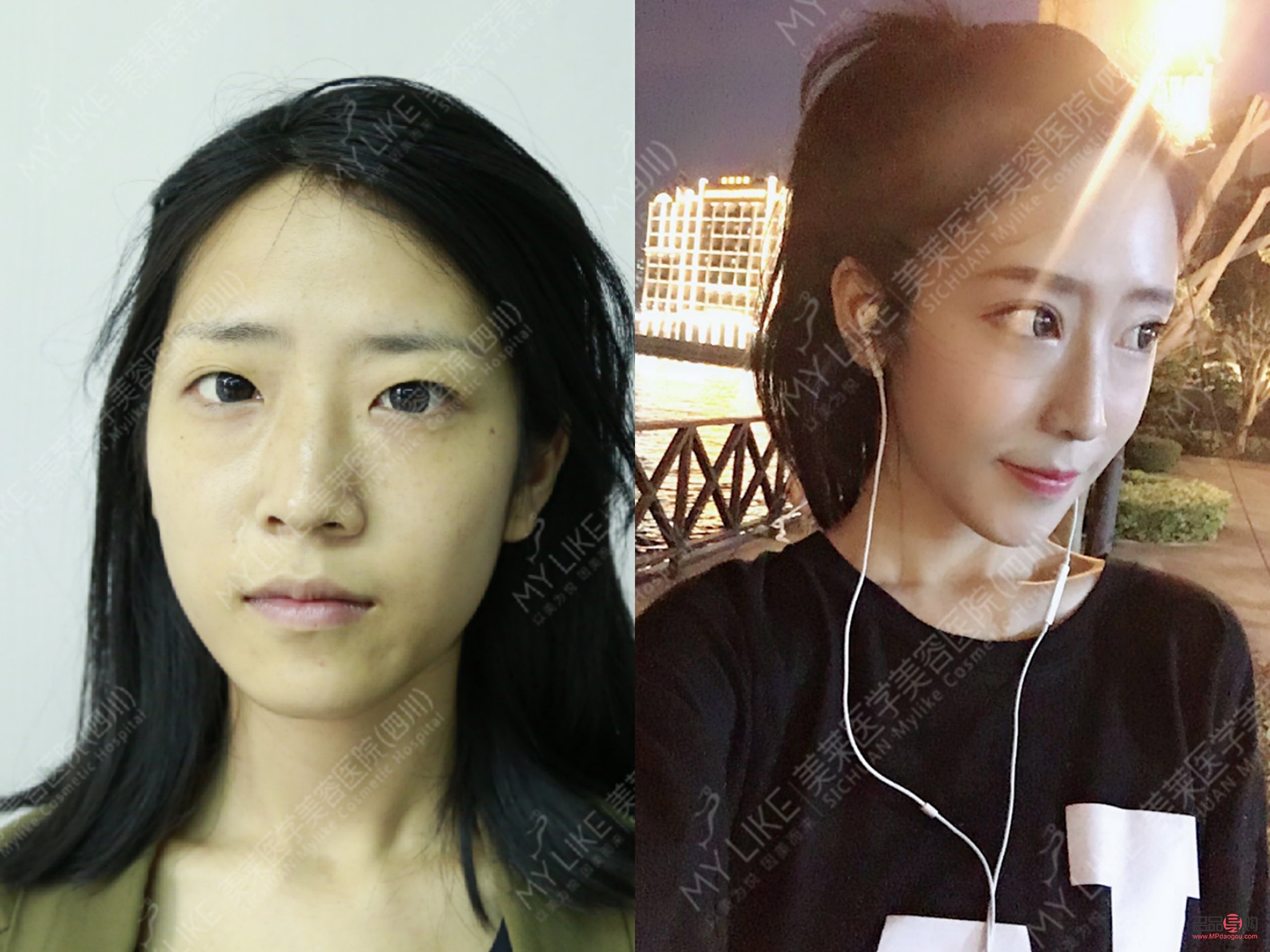 雙眼皮二次手術(shù)：需求、風(fēng)險與考量