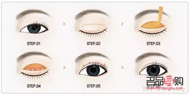 <h3>雙眼皮手術初探：首次嘗試者指南</h3>