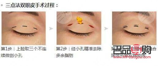 <h3>雙眼皮手術初探：首次嘗試者指南</h3>