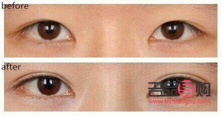 <h3>雙眼皮手術(shù)前后驚艷對比：重塑電眼魅力</h3>