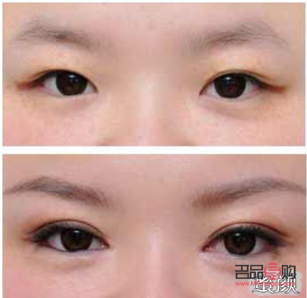 雙眼皮手術(shù)前后驚艷對(duì)比：重塑電眼魅力