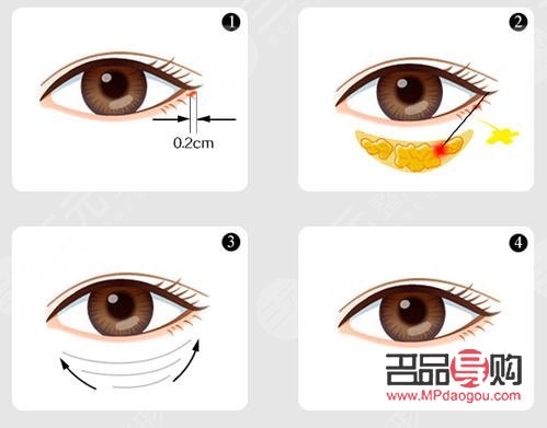 <h3>去眼袋手術前后注意事項全解析</h3>