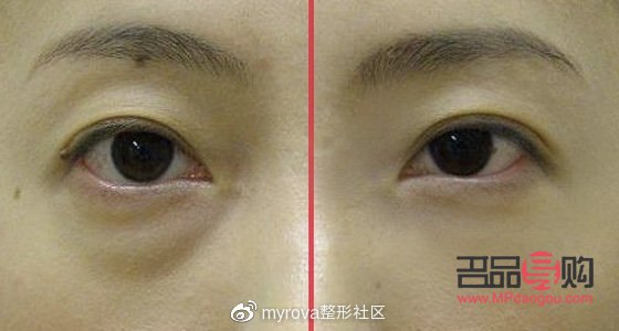 去眼袋手術(shù)前后注意事項(xiàng)全解析