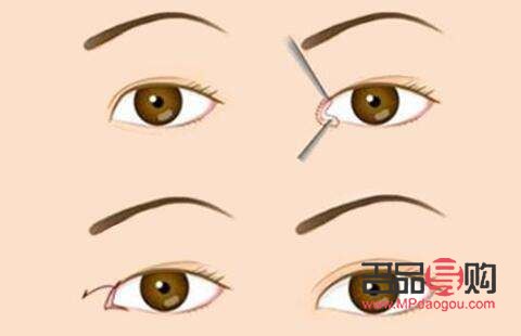 什么季節(jié)去割雙眼皮最好(什么季節(jié)去割雙眼皮最好呢)