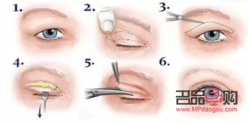 什么季節(jié)去割雙眼皮最好(什么季節(jié)去割雙眼皮最好呢)