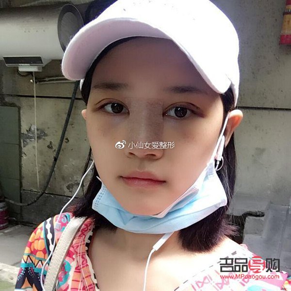 探尋雙眼皮手術(shù)之路：哪種方式恢復(fù)迅速又自然？