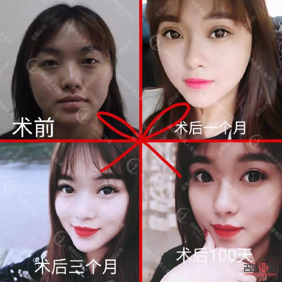 雙眼皮變成好多層眼皮是什么情況(雙眼皮變成好多層眼皮是什么情況圖片)