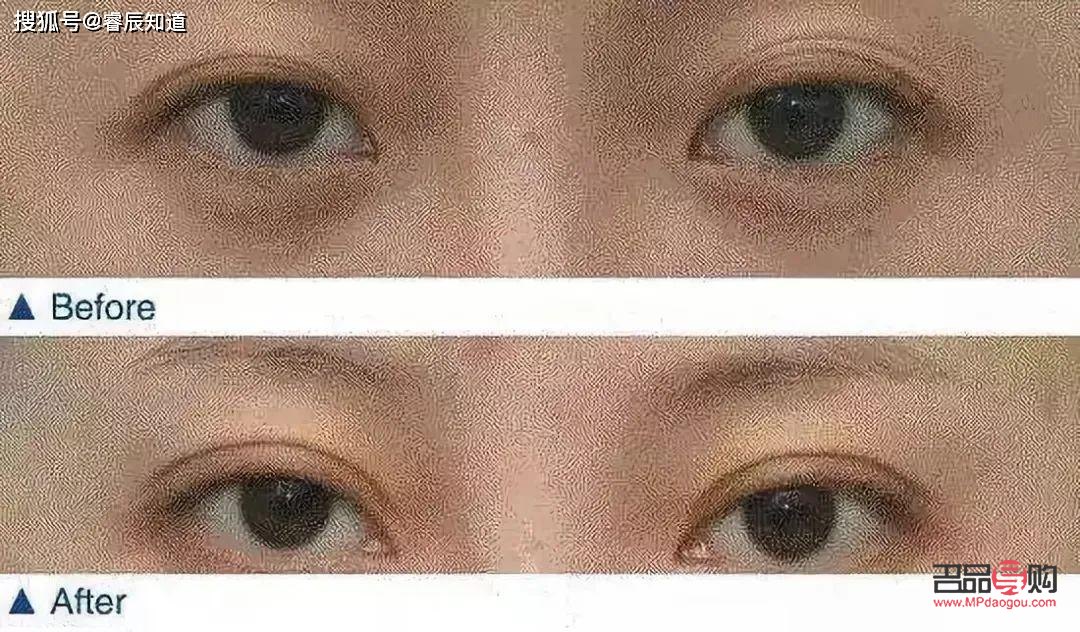 雙眼皮變成好多層眼皮是什么情況(雙眼皮變成好多層眼皮是什么情況圖片)
