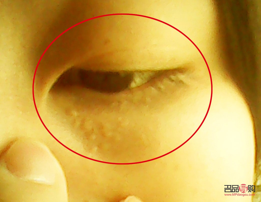 眼周脂肪粒去除小竅門大揭秘