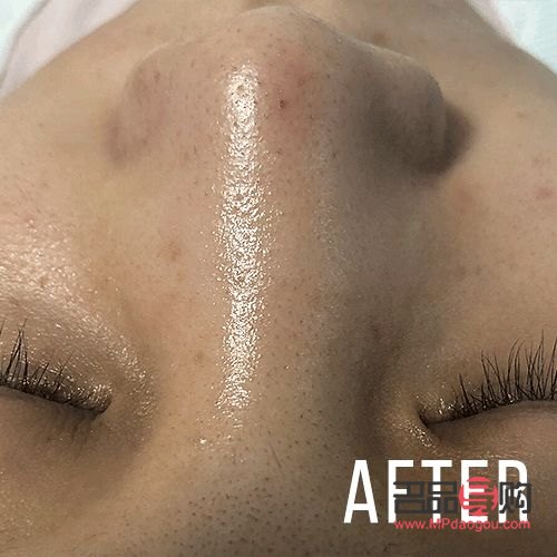 美容去黑頭多少錢(美容去黑頭多少錢一次鼻子)