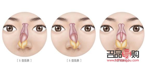 凸眼球矯正手術(shù)多少錢(凸眼球矯正手術(shù)多少錢)