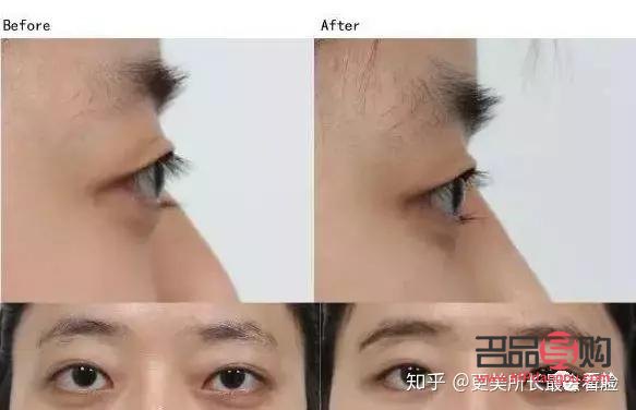 凸眼球矯正手術(shù)多少錢(凸眼球矯正手術(shù)多少錢)