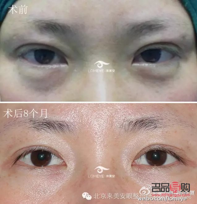 <h3>雙眼皮眼形分類大全，你屬于哪一種？</h3>