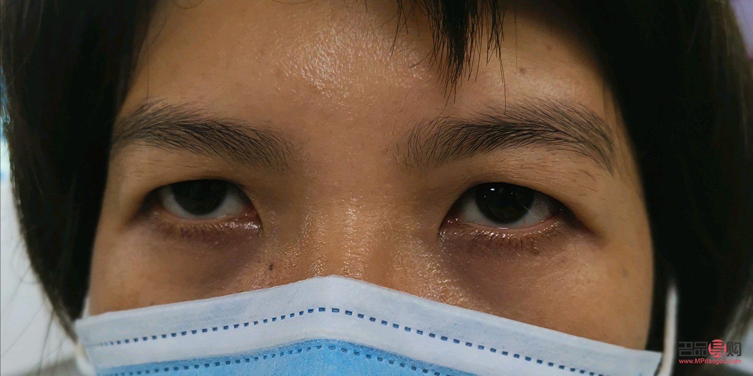 近視與上眼皮耷拉下來的關(guān)聯(lián)及應(yīng)對(duì)措施