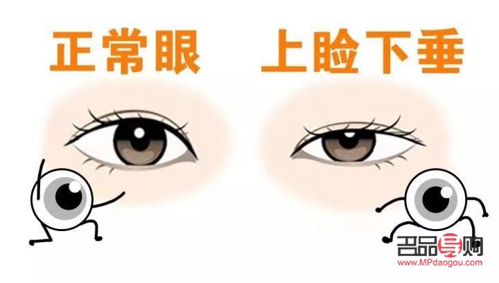近視與上眼皮耷拉下來(lái)的關(guān)聯(lián)及應(yīng)對(duì)措施