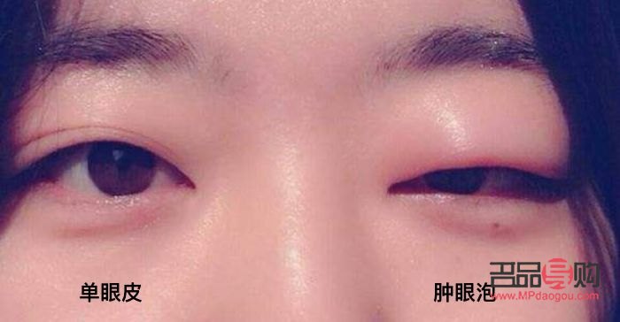 <h3>消除腫眼泡的有效非手術(shù)方法</h3>