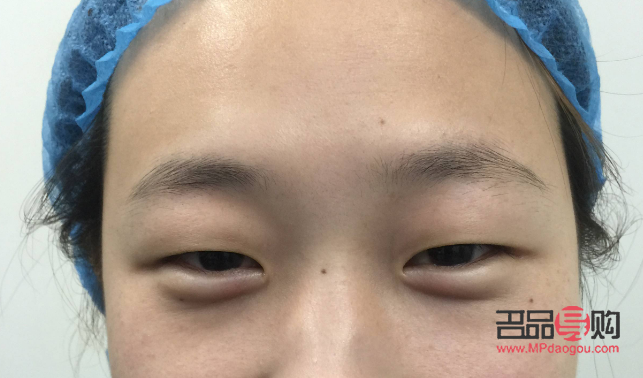 消除腫眼泡的有效非手術(shù)方法