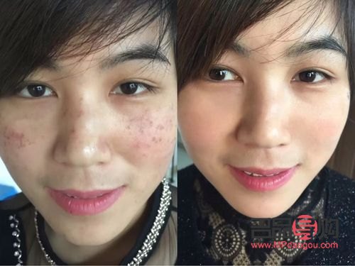 美容祛斑好嗎(美容祛斑好嗎知乎)