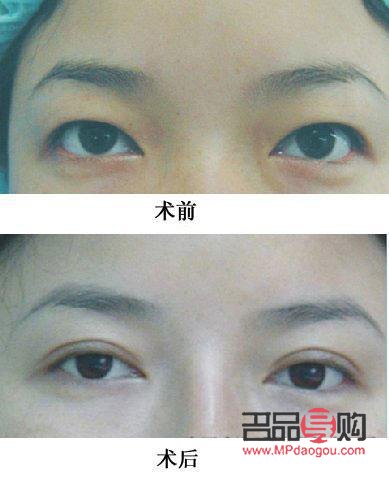 平行雙眼皮圖片 真人(平行雙眼皮圖片 真人圖)