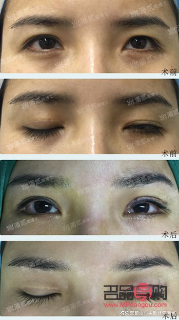 提肌雙眼皮手術(shù)可能帶來(lái)的后遺癥
