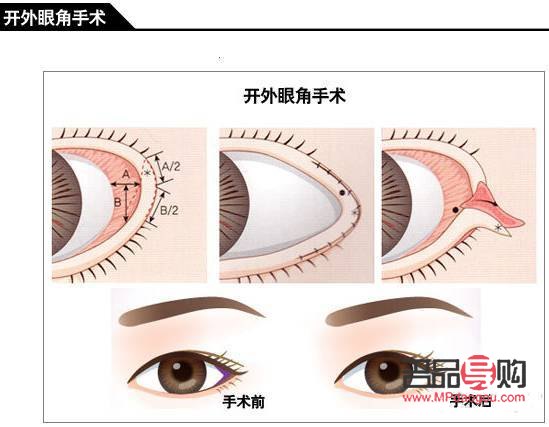 眼角開的有點(diǎn)大了之后還能修復(fù)嗎(眼角開的有點(diǎn)大了之后還能修復(fù)嗎圖片)