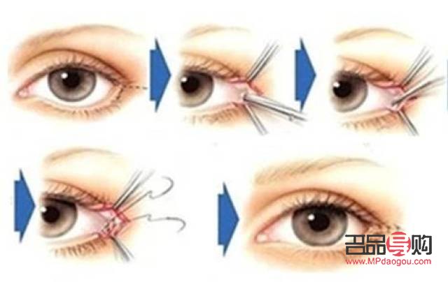 眼角開的有點(diǎn)大了之后還能修復(fù)嗎(眼角開的有點(diǎn)大了之后還能修復(fù)嗎圖片)