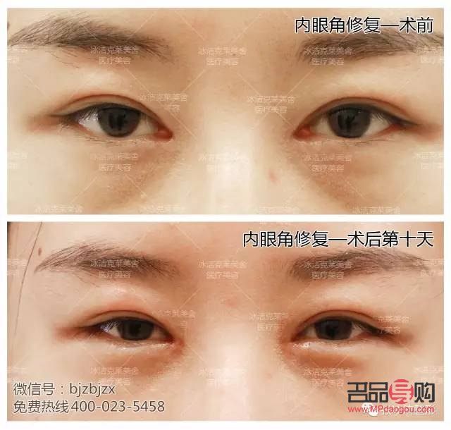 眼角開的有點(diǎn)大了之后還能修復(fù)嗎(眼角開的有點(diǎn)大了之后還能修復(fù)嗎圖片)