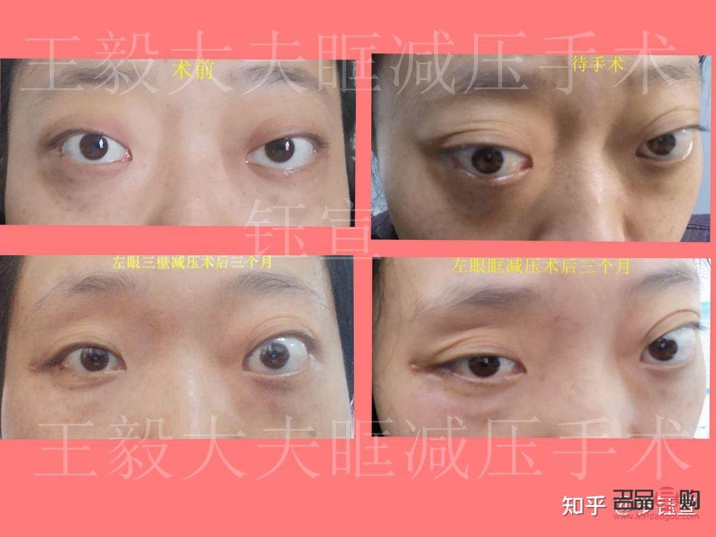 甲亢眼突日?；謴图记?眼眶減壓手術多少錢)