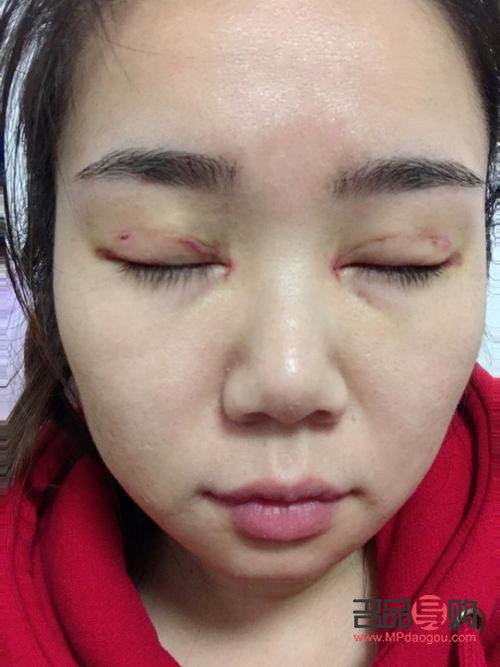 全切雙眼皮一般價位是多少(全切雙眼皮價格一般在多少)