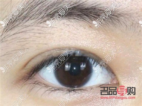 <h3>探索8毫米開扇雙眼皮的魅力</h3>