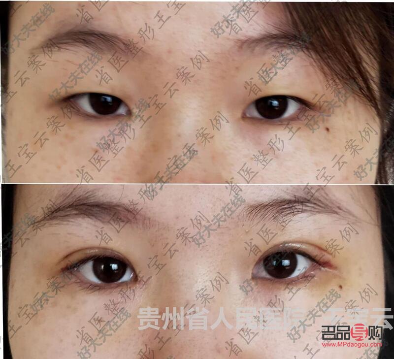 <h3>探索8毫米開扇雙眼皮的魅力</h3>