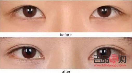 <h3>探索8毫米開扇雙眼皮的魅力</h3>