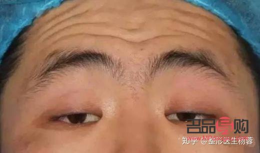 單眼皮肌無力怎樣鍛煉