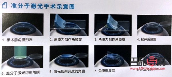 近視眼矯正手術(shù)(近視眼矯正手術(shù)大概多少錢)