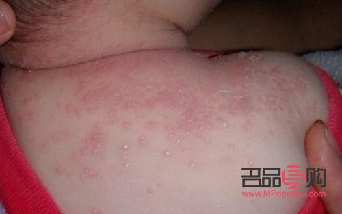 身體出濕疹怎么護理