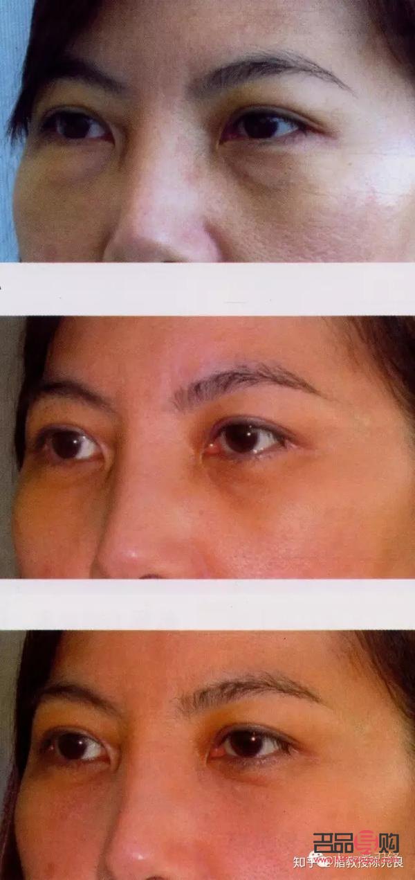 <h3>眼周年輕化手術(shù)包括哪些項目</h3>