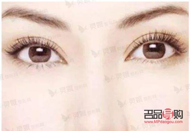 <h3>平扇型雙眼皮優(yōu)點大揭秘</h3>