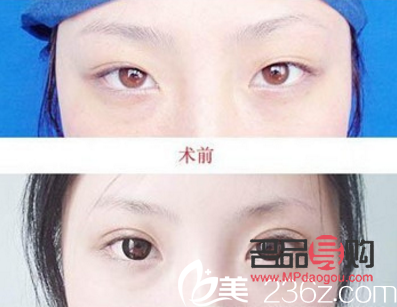 雙眼皮都有什么類型圖片(雙眼皮都有什么類型圖片女)