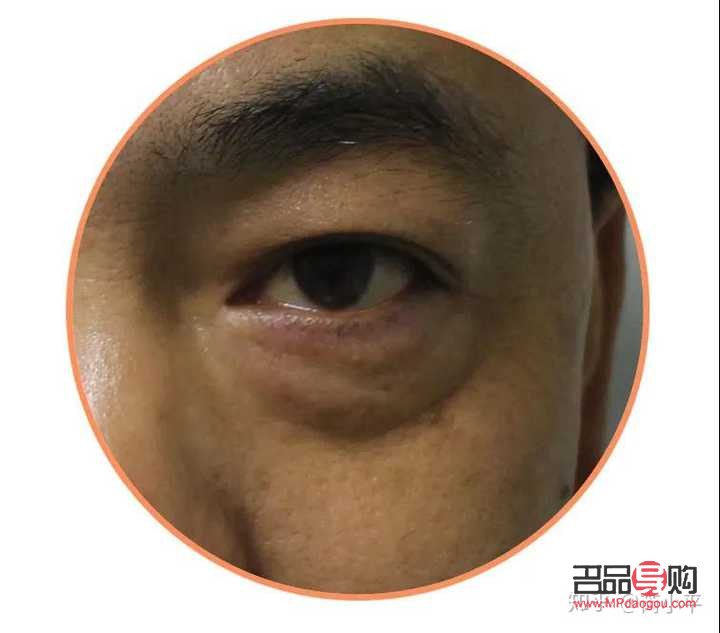 眼袋切除手術(shù)效果持久性探究：幾年內(nèi)無需再次開刀？