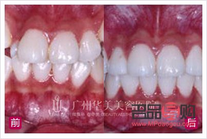虎牙可以美容冠嗎(虎牙可以美容冠嗎多少錢)