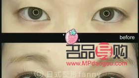 埋線雙眼皮會(huì)留疤嗎？詳細(xì)解析與注意事項(xiàng)